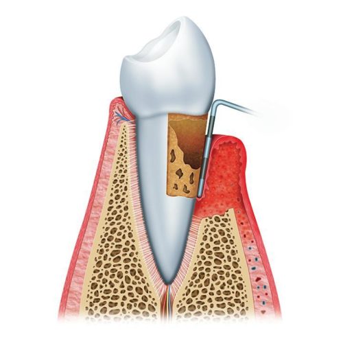 Root canal treatment Root canal treatment