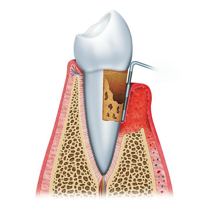 Root canal treatment