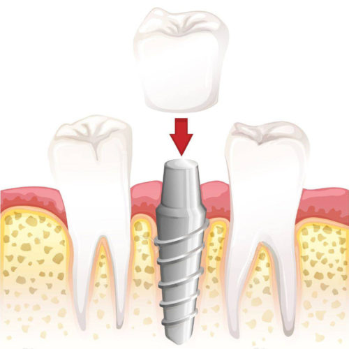 implante dental implante dental