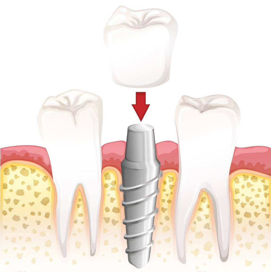 implante dental