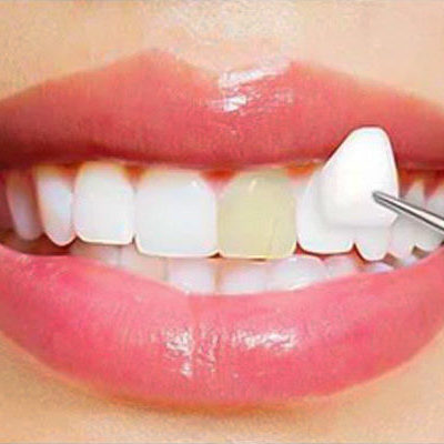 veneers