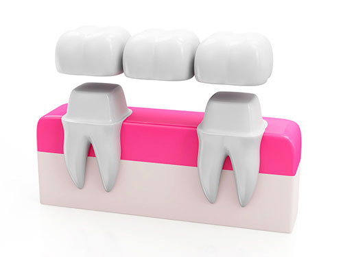 bridge dental
